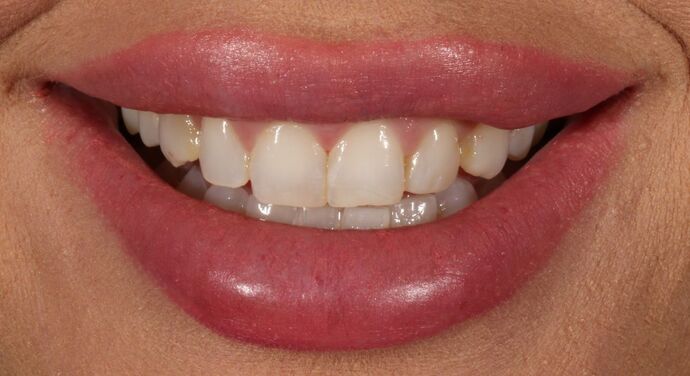 Smile Transformations Case 11 - Before
