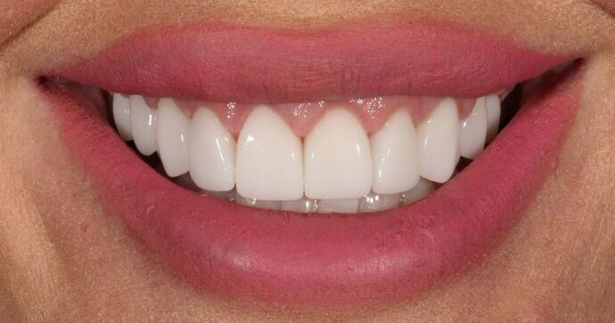 Smile Transformations Case 11 - After