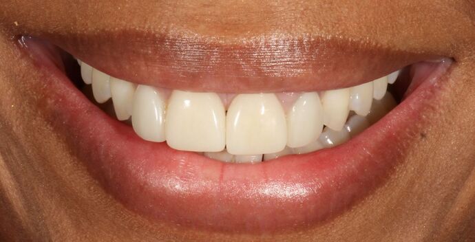 Smile Transformations Case 12 - Before