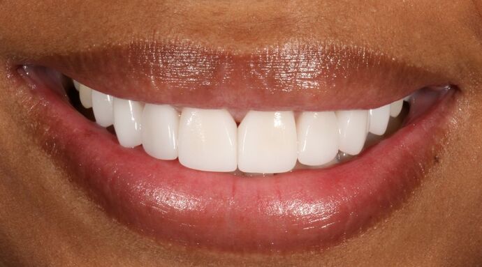Smile Transformations Case 12 - After