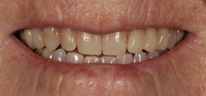 Smile Transformations Case 13 - Before