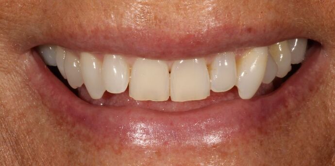 Smile Transformations Case 14 - Before