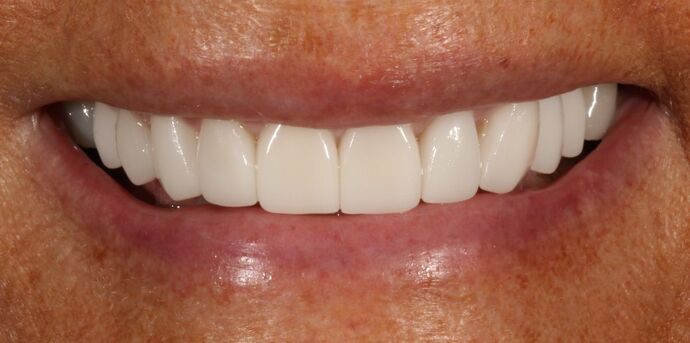 Smile Transformations Case 14 - After