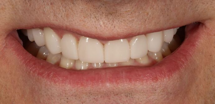 Smile Transformations Case 15 - After