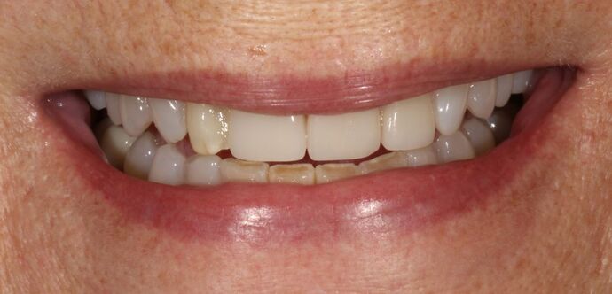 Smile Transformations Case 16 - Before