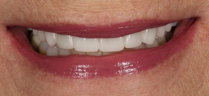 Smile Transformations Case 16 - After