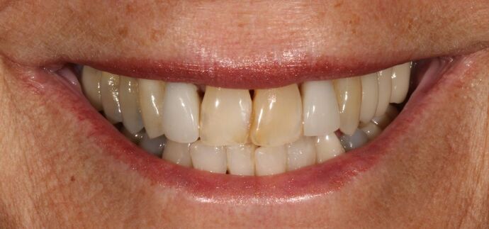 Smile Transformations Case 17 - Before