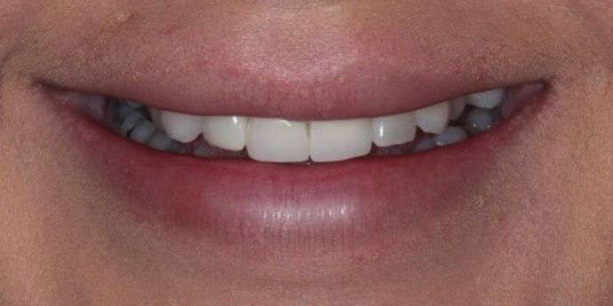 Smile Transformations Case 18 - Before