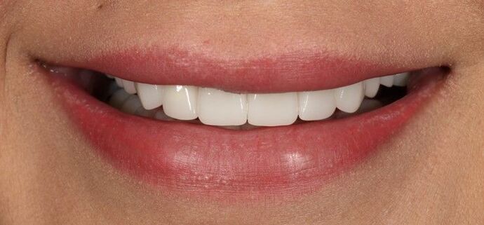 Smile Transformations Case 18 - After