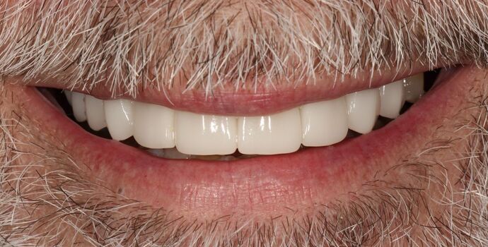 Smile Transformations Case 19 - After