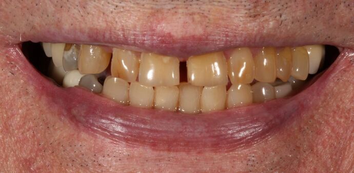 Smile Transformations Case 21 - Before