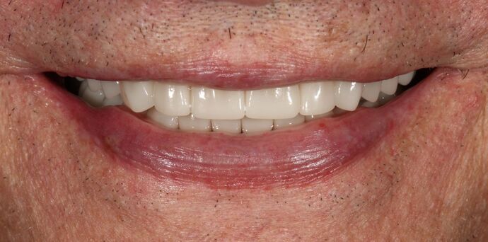 Smile Transformations Case 21 - After