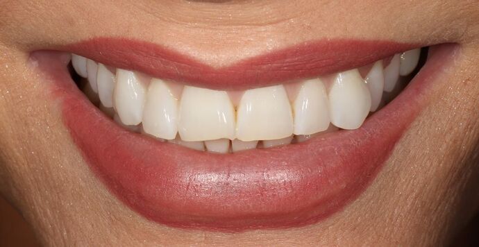 Smile Transformations Case 22 - Before