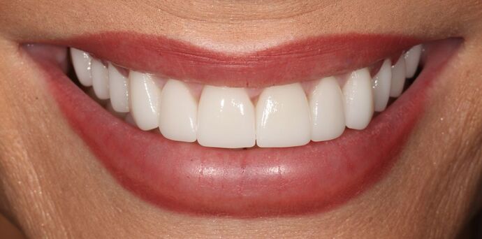 Smile Transformations Case 22 - After