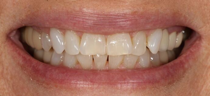 Smile Transformations Case 23 - Before
