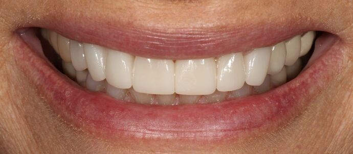 Smile Transformations Case 23 - After
