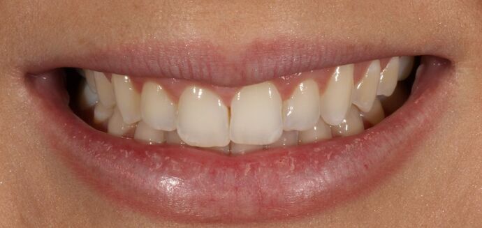 Smile Transformations Case 24 - Before