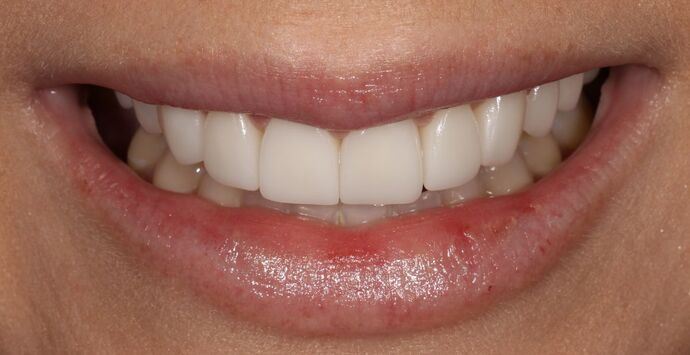 Smile Transformations Case 24 - After