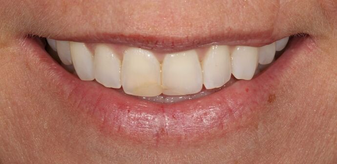 Smile Transformations Case 25 - Before