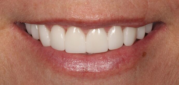 Smile Transformations Case 25 - After