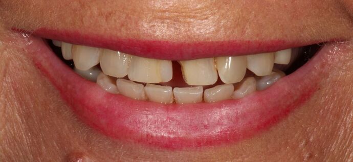 Smile Transformations Case 26 - Before