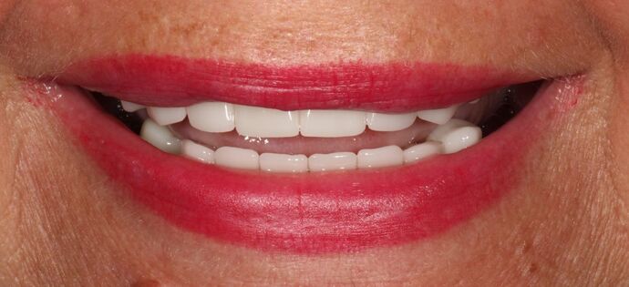 Smile Transformations Case 26 - After