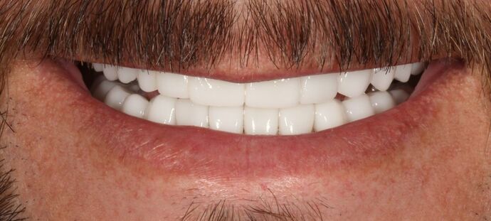 Smile Transformations Case 27 - After