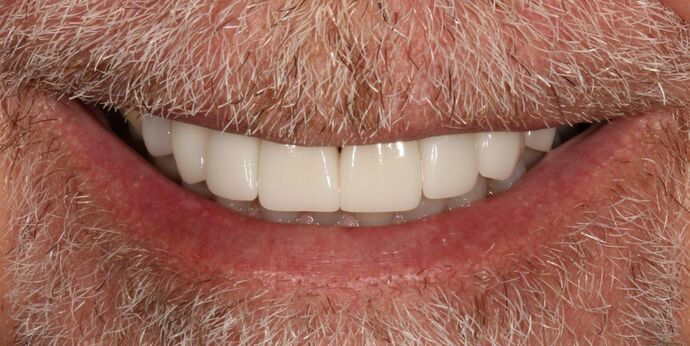 Smile Transformations Case 28 - After