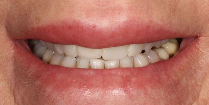 Smile Transformations Case 29 - Before