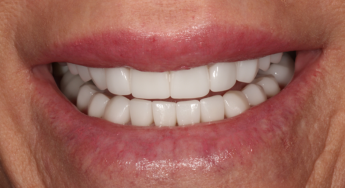 Smile Transformations Case 29 - After