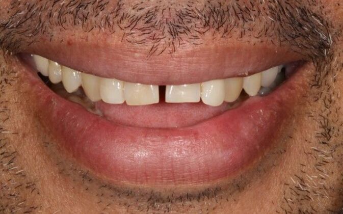 Smile Transformations Case 30 - Before