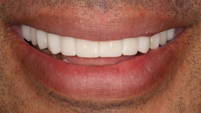 Smile Transformations Case 30 - After