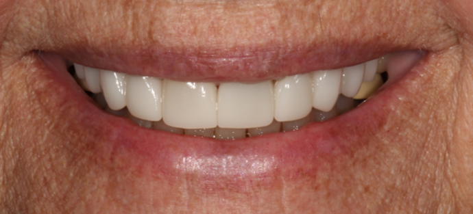 Smile Transformations Case 31 - After
