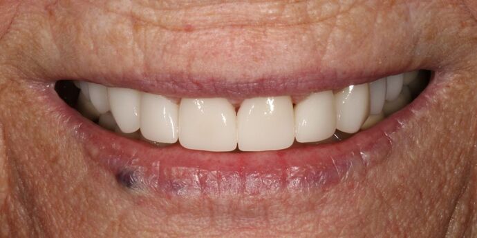 Smile Transformations Case 32 - After