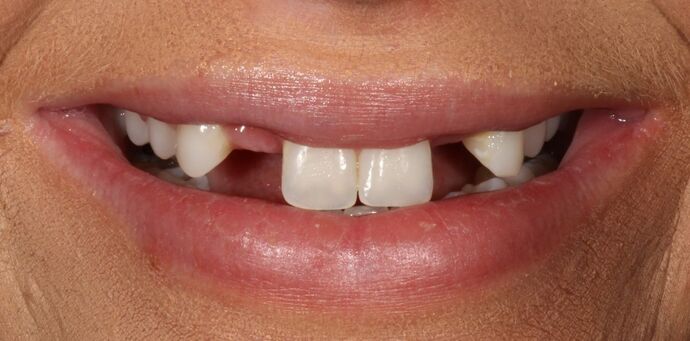 Smile Transformations Case 33 - Before