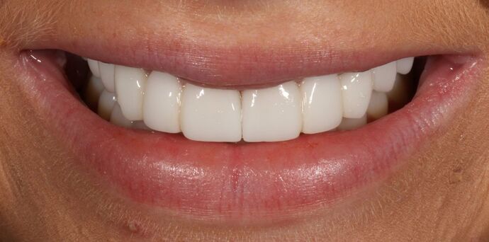 Smile Transformations Case 33 - After