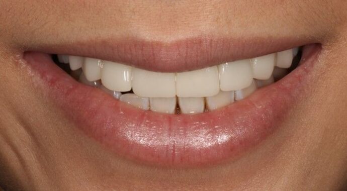 Smile Transformations Case 34 - After