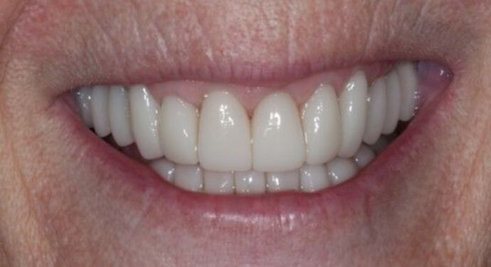 Smile Transformations Case 35 - After