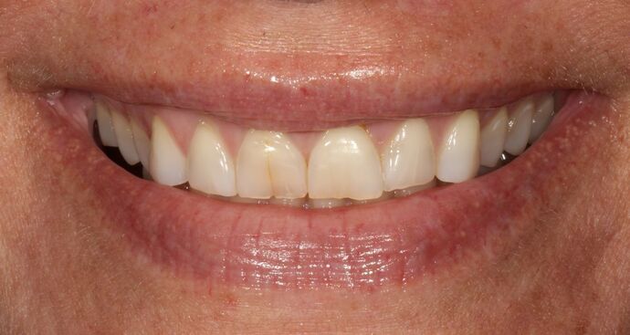 Smile Transformations Case 36 - Before