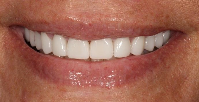 Smile Transformations Case 36 - After