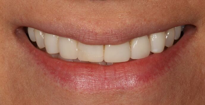 Smile Transformations Case 37 - Before