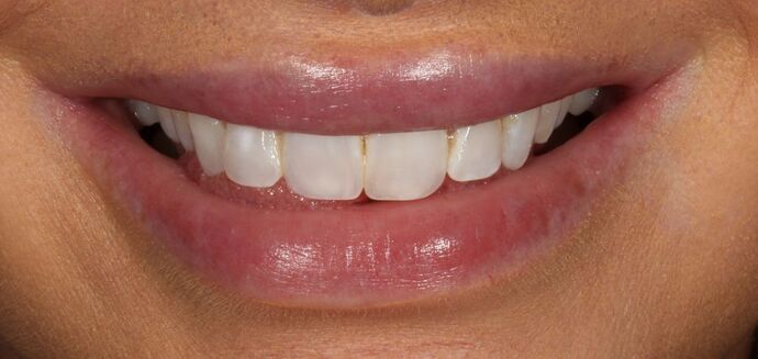 Smile Transformations Case 38 - Before