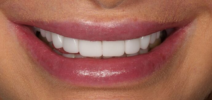 Smile Transformations Case 38 - After