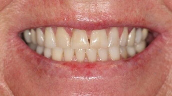 Smile Transformations Case 39 - Before