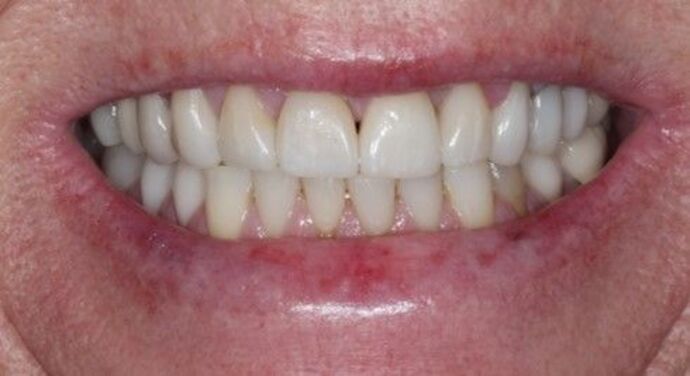 Smile Transformations Case 39 - After