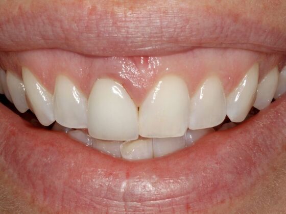 Smile Makeover & Veneers: Becky - Before