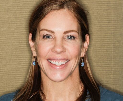 Smile Makeover & Veneers: Becky - Before