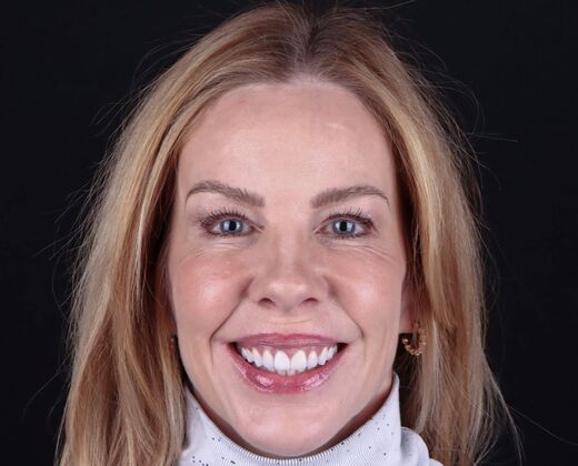 Smile Makeover & Veneers: Becky - After