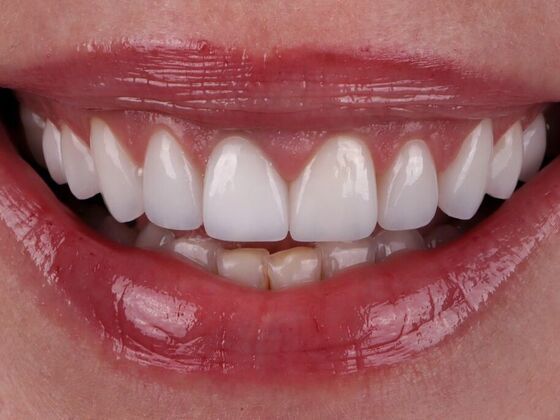 Smile Makeover & Veneers: Becky - After