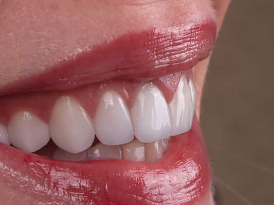 Smile Makeover & Veneers Becky